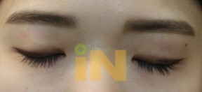 쌍꺼풀 수술은 싫고 눈두덩이가 통통한 사람들이 선호한다는 수술 jpg | 인스티즈