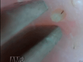 화이트 헤드 제거하는 짤 .GIF | 인스티즈