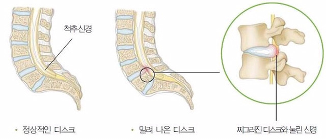 진심 이 통증 못느껴본 사람은 축복받았다고 생각하는 병 | 인스티즈