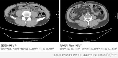침묵의 암살자 뱃속의 시한폭탄 내장지방의 위험성 | 인스티즈