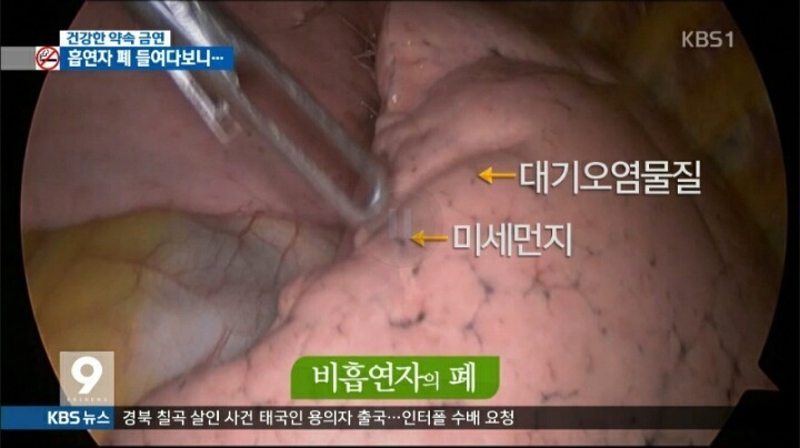 흡연자의 폐 | 인스티즈
