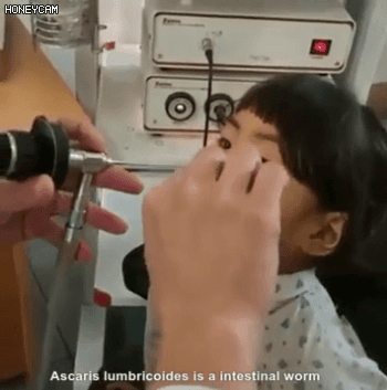 어린아이 코에 들어간 거머리 (혐오주의) | 인스티즈