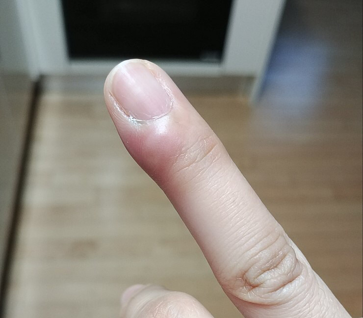 손발톱 깊게 자르면 고생하는것 | 인스티즈